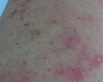 如何有效护理体癣患者
