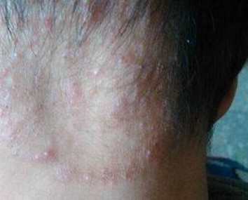 体癣病人要小心的问题有那些呢