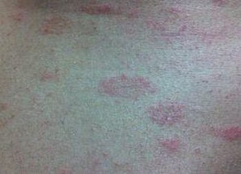 患上体癣后有什么值得注意