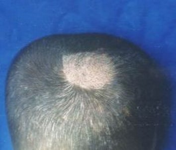 黄癣的症状特征
