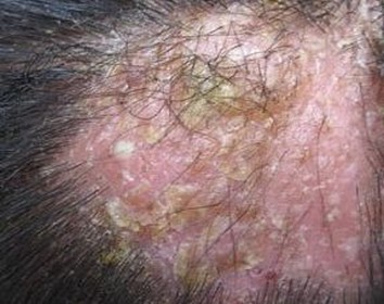 黄癣患者有哪些表现表现