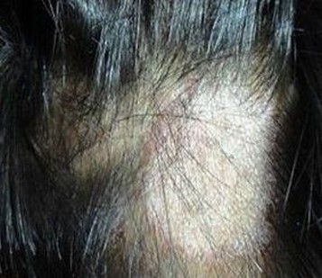 脓癣的症状特点有什