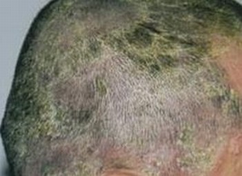 儿童头癣与宠物有关系吗