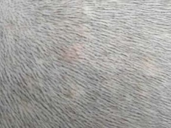 儿童为什么好发头癣