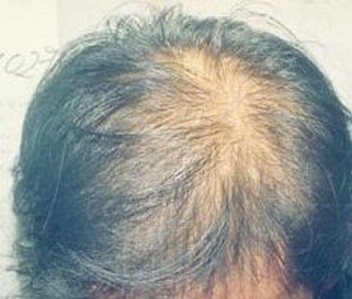 孩子得了头癣要如何护理
