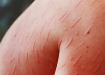 常见丘疹性荨麻疹的症状