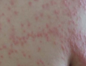 平常挤压的红斑也有可能是荨麻疹 