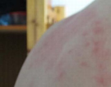 青岛常见荨麻疹的治疗好措施 