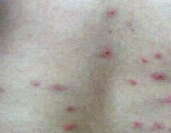 青岛患丘疹性荨麻疹要如何治疗