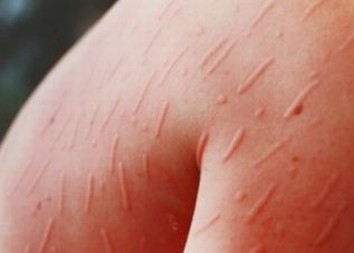 青岛慢性荨麻疹怎样治疗呢