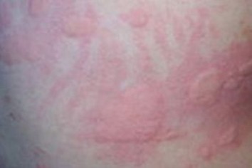 青岛人工荨麻疹的治疗好措施
