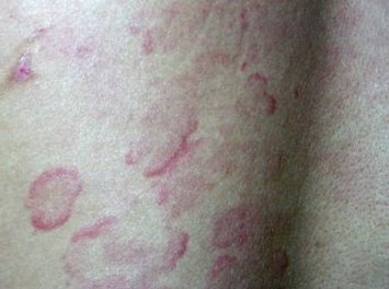 丘疹性荨麻疹吃什么中药