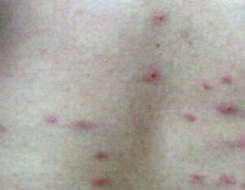 丘疹性荨麻疹传染么