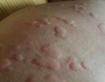 丘疹性荨麻疹发病的症状图