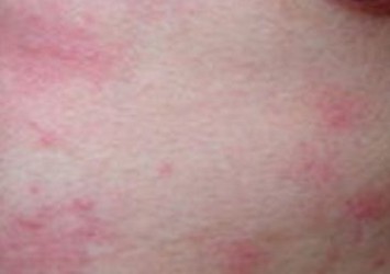 丘疹性荨麻疹日常该有哪些要注意