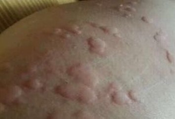 丘疹性荨麻疹显著症状