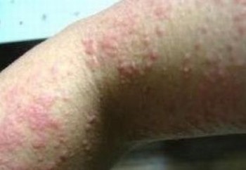 皮肤病专家解释荨麻疹的生活禁忌有