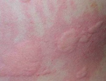 青岛慢性荨麻的疹治疗的手法