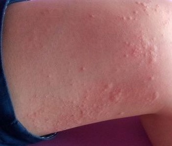 青岛丘疹性荨麻疹的较好治疗的手法