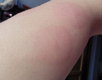 儿童丘疹性荨麻疹的症状