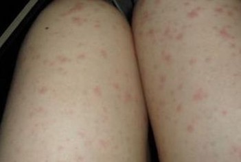 青岛荨麻疹不治疗行吗