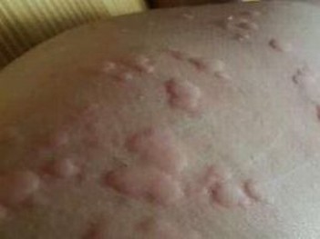 青岛荨麻疹的症状及治疗