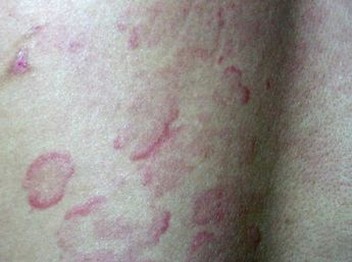 丘疹性荨麻疹的护理原则