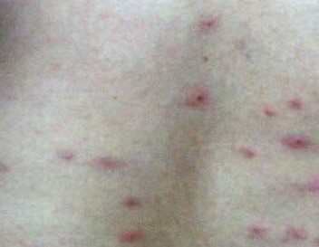 丘疹性荨麻疹的起因