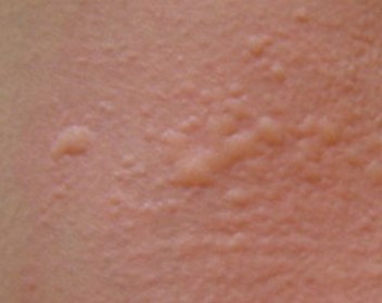丘疹性荨麻疹的伤害有什么