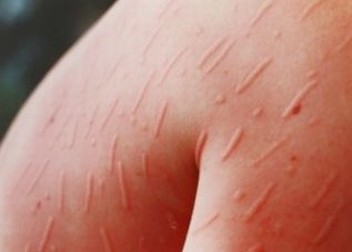 丘疹性荨麻疹日常该有哪些要注意