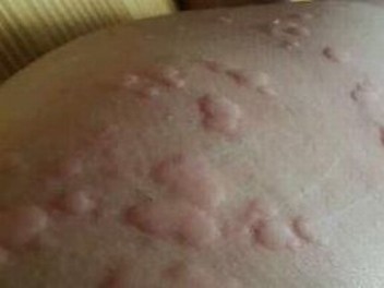 急性荨麻疹在青岛皮肤病研究院治好