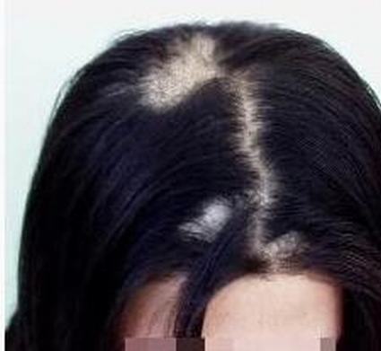 斑秃病人要小心的日常护发细节