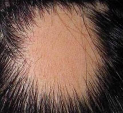斑秃患者的临床症状有哪些