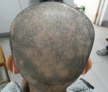 斑秃患者平时生活之中的注意什么事情