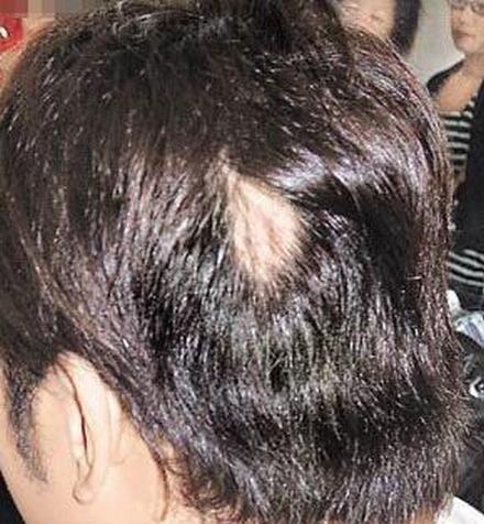 产生斑秃的病因有哪些