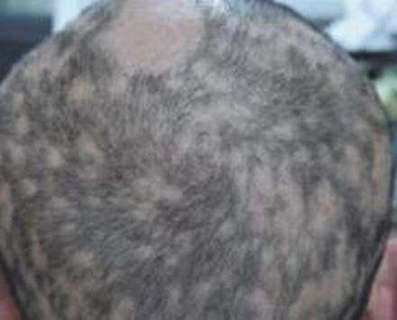 斑秃有哪些治疗上的误区呢