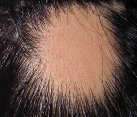 常见的引起斑秃的有什么原因 