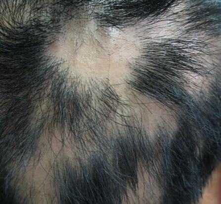 发生斑秃可以如何治疗 
