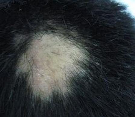患上斑秃后有什么难以估量的后果