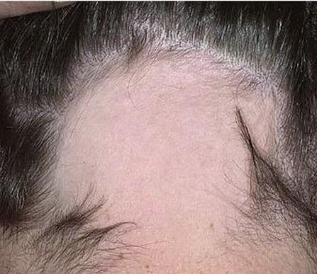 男性斑秃都症状有什么