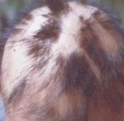 引起斑秃的病因是什么