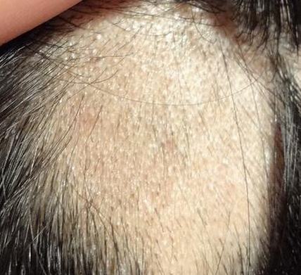 斑秃的预防哪些措施