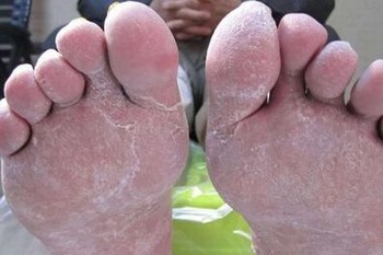 “脚气”“脚癣”要分清 