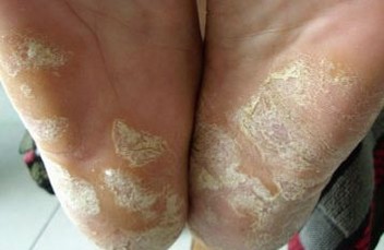 脚气可带来什么伤害