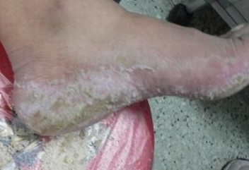 脚气日常该注意什么事情