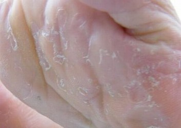 脚气易与哪些疾病混淆