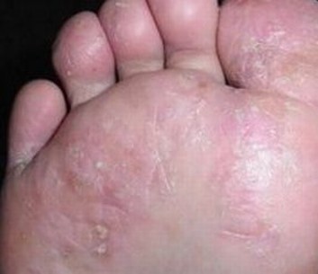 脚气有哪些常见症状