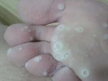 脚气有哪些因素