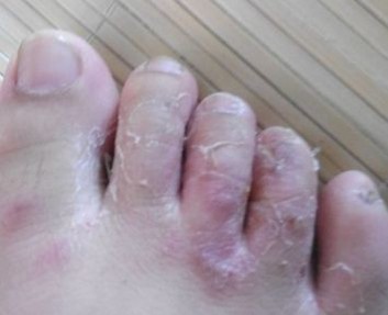 脚气有什么常见症状