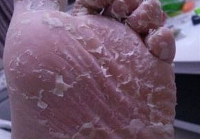 脚气的发生多数是由真菌感染的,所以说,治愈彻底消灭真菌,才能彻底的